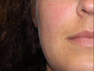 Patient #83969: IPL for Blood Vessels Before Image