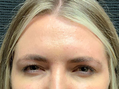 Patient #80222-1: Botox After Image