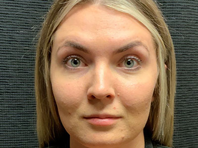 Patient #80222-1: Botox After Image