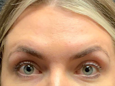 Patient #80222-1: Botox After Image
