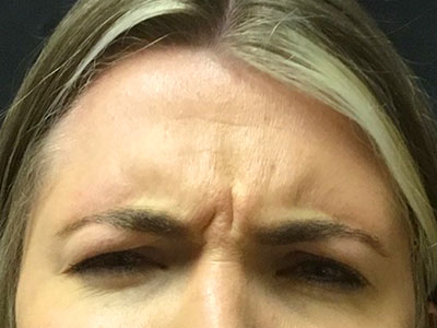 Patient #80222-1: Botox Before Image