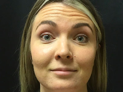 Patient #80222-1: Botox Before Image