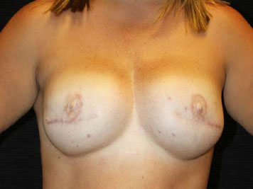 Patient #7930: Breast Reconstruction After Image