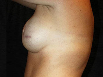 Patient #7930: Breast Reconstruction After Image