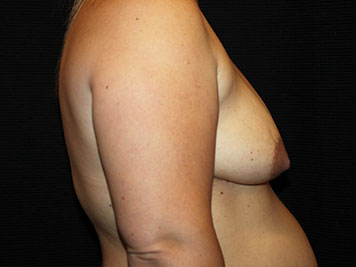 Patient #7930: Breast Reconstruction Before Image
