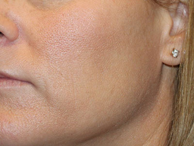 Patient #32375: Chemical Peel After Image
