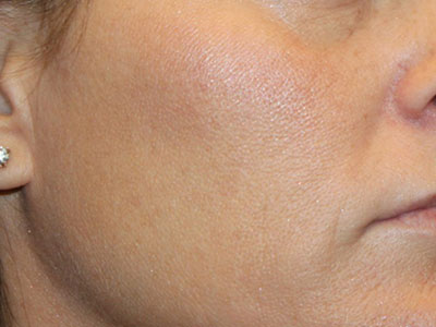 Patient #32375: Chemical Peel After Image