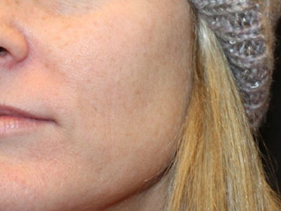 Patient #32375: Chemical Peel Before Image