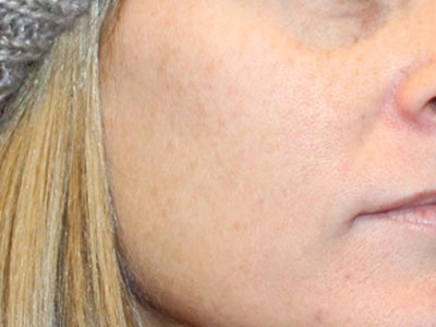 Patient #32375: Chemical Peel Before Image