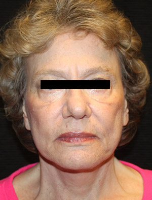 Patient #39858: Facelift, Fat Injections, & Neck Lift After Image