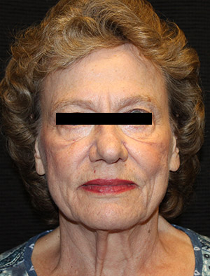 Patient #39858: Facelift, Fat Injections, & Neck Lift Before Image