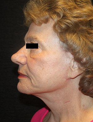 Patient #39858: Facelift, Fat Injections, & Neck Lift After Image