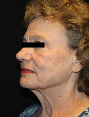 Patient #39858: Facelift, Fat Injections, & Neck Lift Before Image