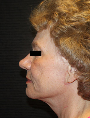 Patient #39858: Facelift, Fat Injections, & Neck Lift After Image
