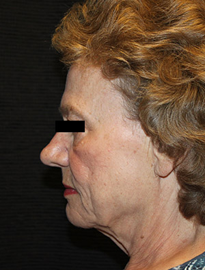 Patient #39858: Facelift, Fat Injections, & Neck Lift Before Image