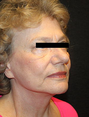 Patient #39858: Facelift, Fat Injections, & Neck Lift After Image