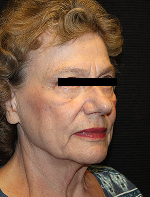 Patient #39858: Facelift, Fat Injections, & Neck Lift Before Image