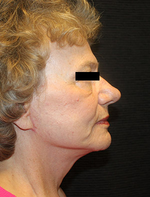 Patient #39858: Facelift, Fat Injections, & Neck Lift After Image