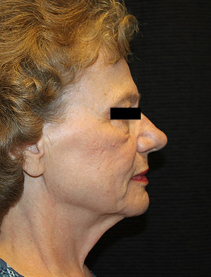 Patient #39858: Facelift, Fat Injections, & Neck Lift Before Image