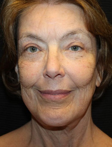 Patient #92721-1: Facelift, Fat Injections, Blepharoplasty, & Neck Lift After Image
