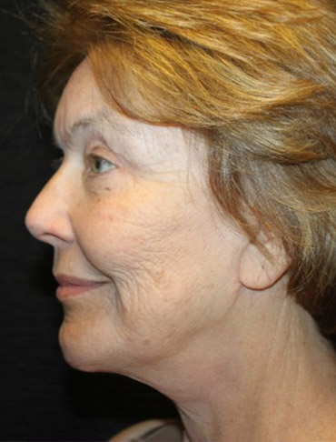 Patient #92721-1: Facelift, Fat Injections, Blepharoplasty, & Neck Lift After Image