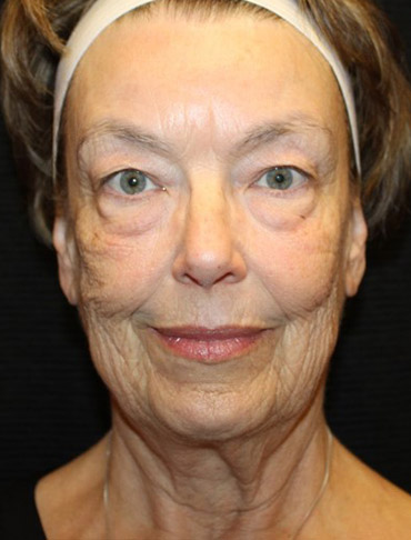 Patient #92721-1: Facelift, Fat Injections, Blepharoplasty, & Neck Lift Before Image