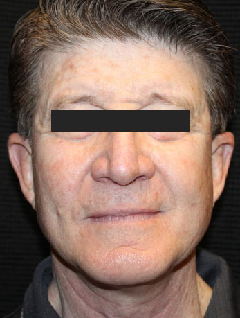 Patient #10133: In-Office Facelift with Fat Injections After Image
