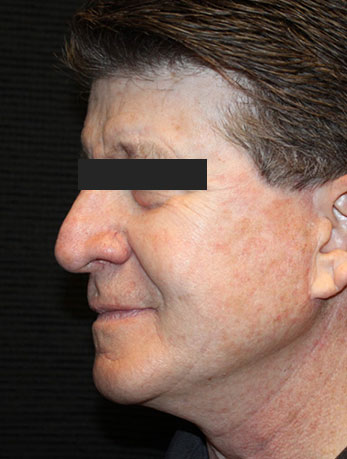 Patient #10133: In-Office Facelift with Fat Injections After Image