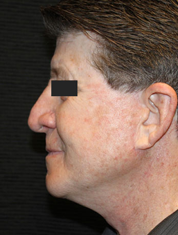 Patient #10133: In-Office Facelift with Fat Injections After Image