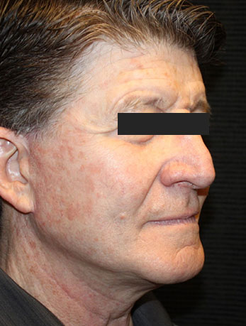 Patient #10133: In-Office Facelift with Fat Injections After Image