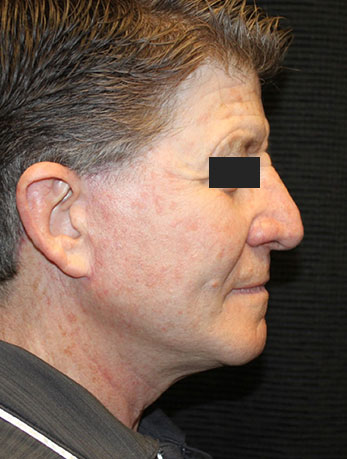 Patient #10133: In-Office Facelift with Fat Injections After Image