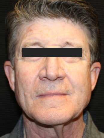 Patient #10133: In-Office Facelift with Fat Injections Before Image