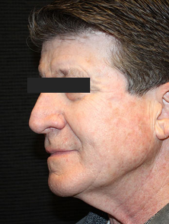 Patient #10133: In-Office Facelift with Fat Injections Before Image