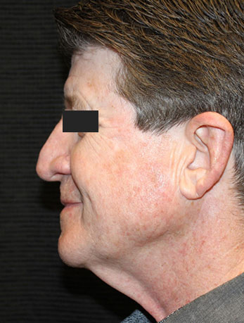 Patient #10133: In-Office Facelift with Fat Injections Before Image