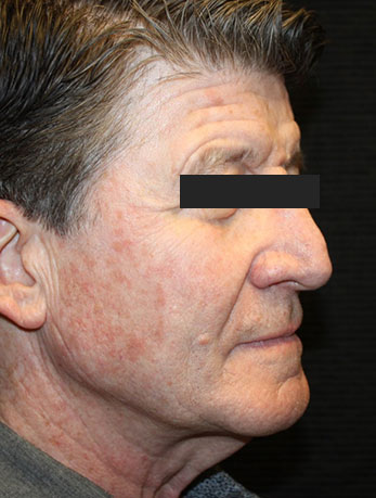 Patient #10133: In-Office Facelift with Fat Injections Before Image