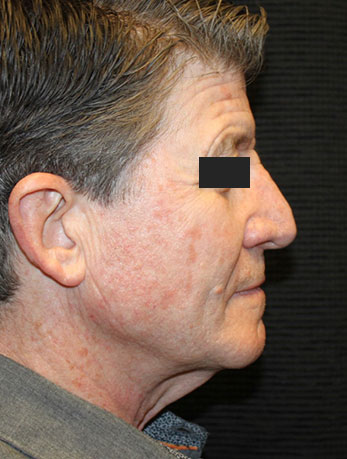 Patient #10133: In-Office Facelift with Fat Injections Before Image
