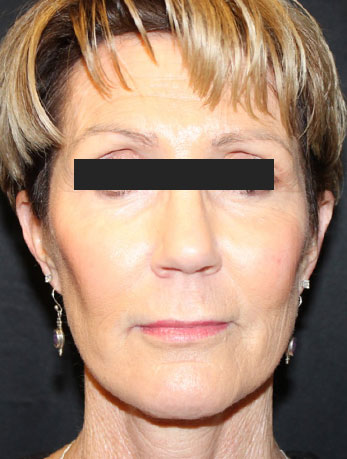 Patient #76396: In-Office Facelift After Image