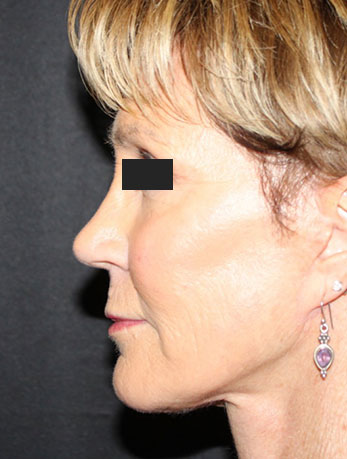 Patient #76396: In-Office Facelift After Image