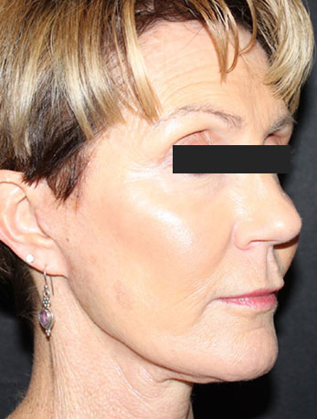 Patient #76396: In-Office Facelift After Image