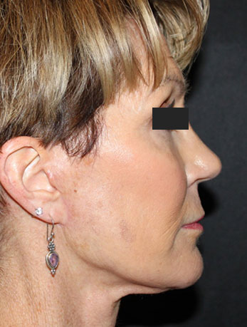 Patient #76396: In-Office Facelift After Image
