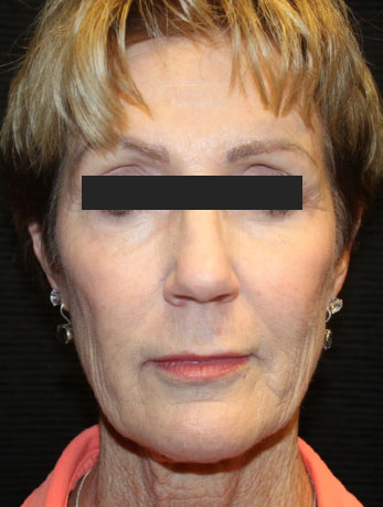 Patient #76396: In-Office Facelift Before Image