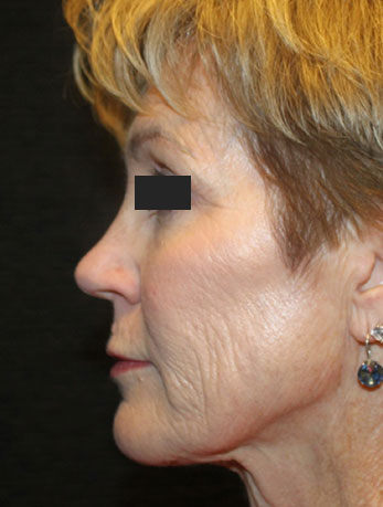 Patient #76396: In-Office Facelift Before Image