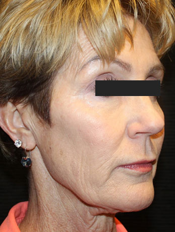 Patient #76396: In-Office Facelift Before Image
