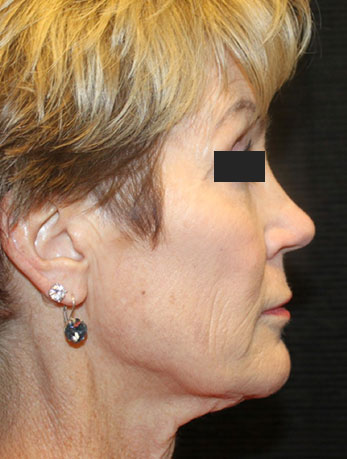 Patient #76396: In-Office Facelift Before Image