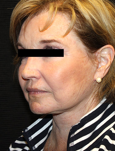 Patient #44397: Facelift, Neck Lift, Fat Injections, CO2 Laser After Image