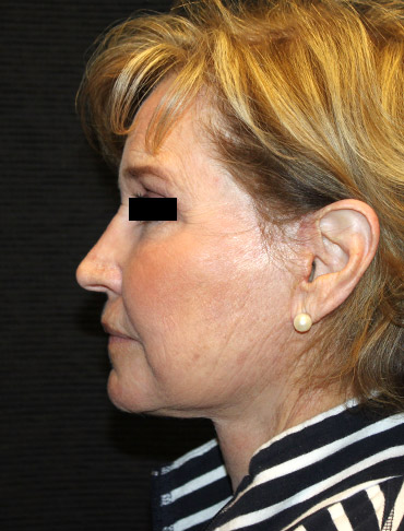 Patient #44397: Facelift, Neck Lift, Fat Injections, CO2 Laser After Image