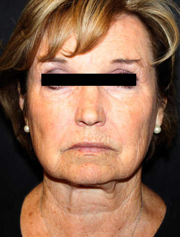 Patient #44397: Facelift, Neck Lift, Fat Injections, CO2 Laser Before Image