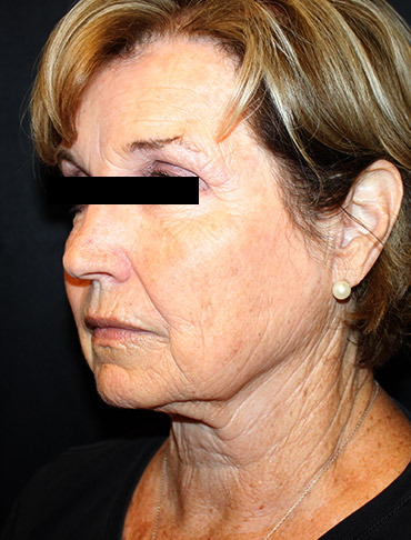 Patient #44397: Facelift, Neck Lift, Fat Injections, CO2 Laser Before Image