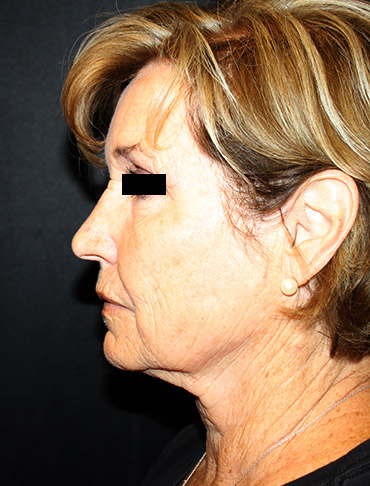 Patient #44397: Facelift, Neck Lift, Fat Injections, CO2 Laser Before Image
