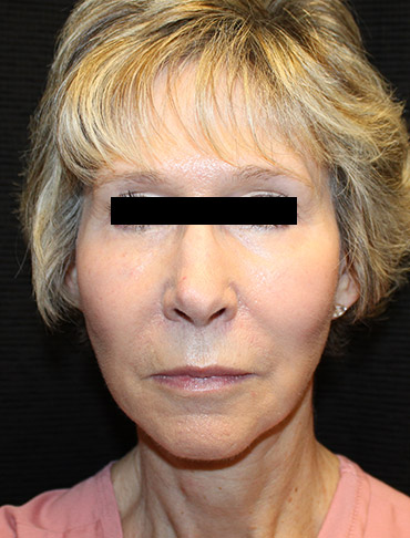 Patient #69932: Facelift & Fat Injections After Image